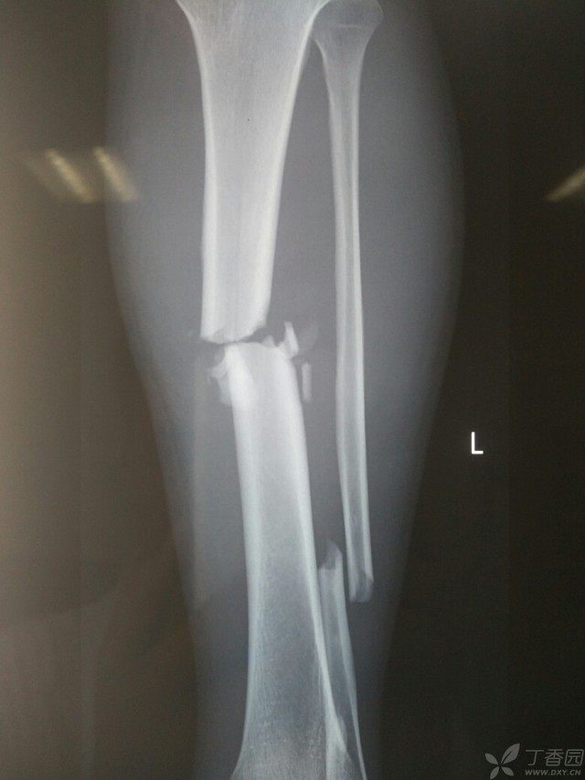 科技重塑脛腓骨骨折康復之旅，引領未來體驗新篇章