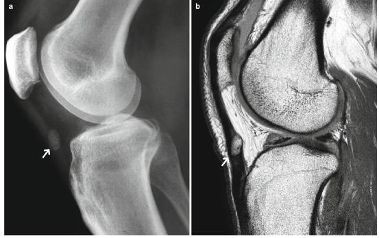 髕腱炎成為醫(yī)學焦點，從幕后走向舞臺中央的最新進展