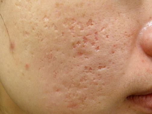 最新痘坑撫平神器，科技重塑肌膚之美，自信生活從此開始