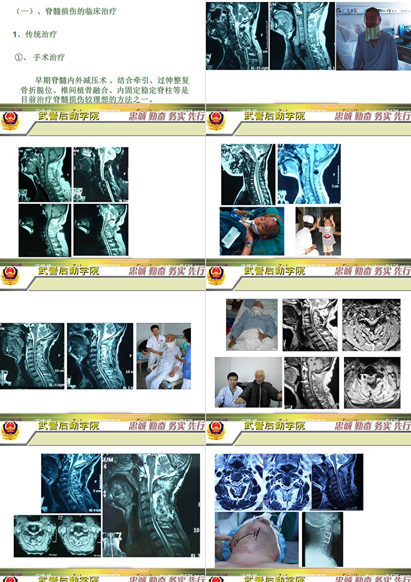 2023年脊髓損傷研究新進(jìn)展，里程碑式的突破與日常奇妙變化