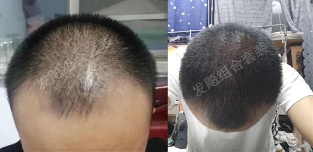 治愈脫發(fā)最新重大突破，重塑自信，希望之光再現(xiàn)