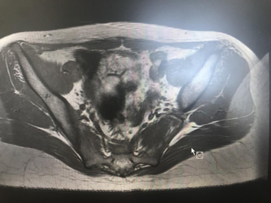 幼稚子宮最新治療與步驟指南
