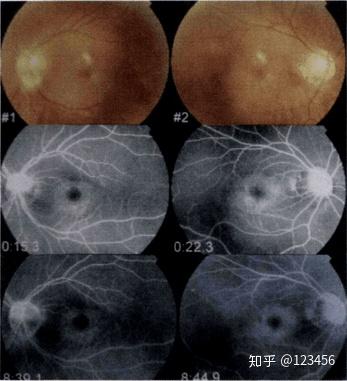最新藥肺炎詳解，你需要知道的一切——健康小紅書